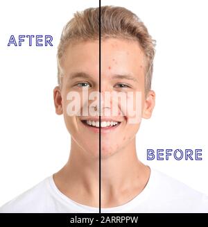 Teenage boy before and after acne treatment on white background Stock ...