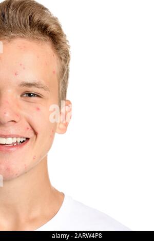 Teenage boy with acne problem on white background Stock Photo