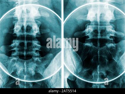 X ray of human lumbar spine Stock Photo - Alamy