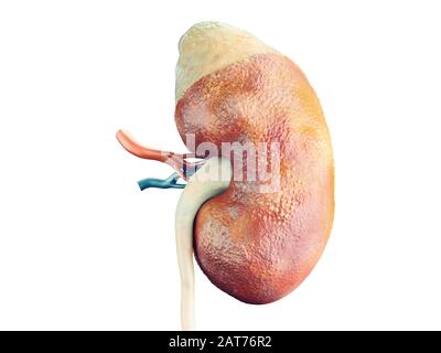 adrenal kidney failure
