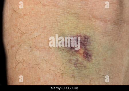 Haematoma after blood sampling, Germany Stock Photo