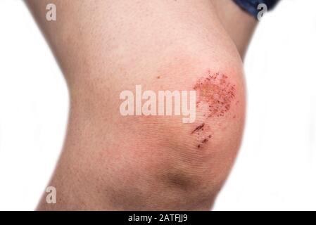 Woman scratch skin on the knee. Injury concept Stock Photo - Alamy