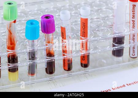 Coronavirus blood test 2019-nCoV,SARS-CoV, MERS-CoV chinese infection blood test in Laboratory Stock Photo