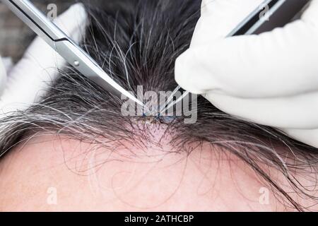 Closeup, doctor removing stitches from a healed wound on a man ´s head, suture, forceps and scissors Stock Photo