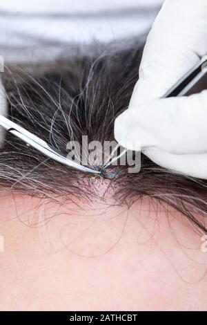 Doctor removing stitches with a pincette and scissors, wound suture on a man ´s forehead, closeup Stock Photo