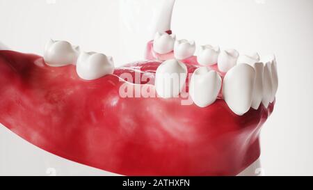 Tooth implantation picture series 1 of 13 - 3D Rendering Stock Photo