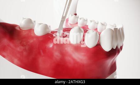 Tooth implantation picture series 2 of 13 - 3D Rendering Stock Photo