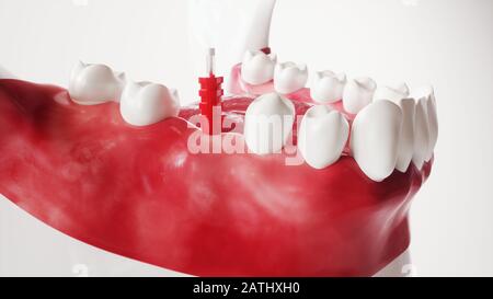 Tooth implantation picture series 91 of 13 - 3D Rendering Stock Photo
