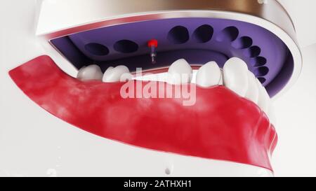 Tooth implantation picture series 10 of 13 - 3D Rendering Stock Photo
