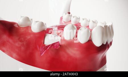 Tooth implantation picture series 7 of 13 - 3D Rendering Stock Photo