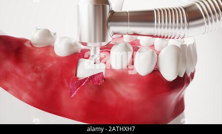 Tooth implantation picture series 4 of 13 - 3D Rendering Stock Photo
