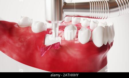 Tooth implantation picture series 5 of 13 - 3D Rendering Stock Photo