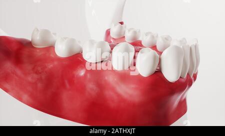 Tooth implantation picture series 13 of 13 - 3D Rendering Stock Photo