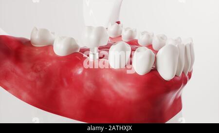 Tooth implantation picture series 12 of 13 - 3D Rendering Stock Photo