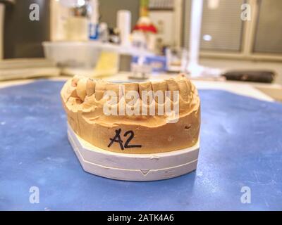 Metal-ceramic dental crown is tried on an gypsum model. Dental care concept. Human teeth with dentures on 3d model Stock Photo