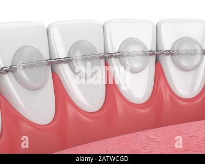 3d render of dental bonded retainer on lower jaw over white background Stock Photo