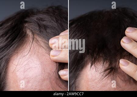 Man Before And After Successful Hair Loss Treatment Stock Photo