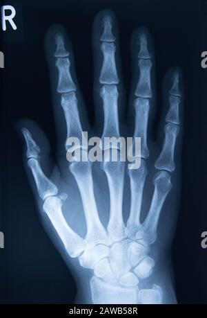 x-ray image hand and finger Stock Photo