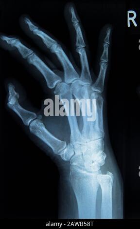 X Ray of human hand with broken wrist, fracture of radius, xray Stock ...