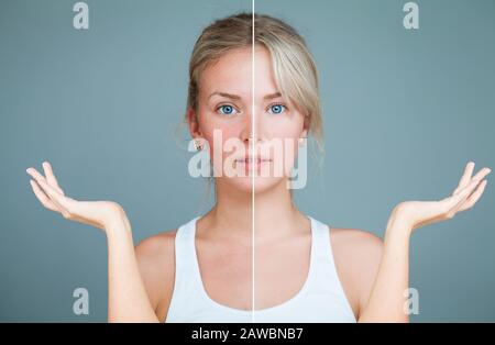 Young Woman with hands raised. Perfect Skin and Skin Problem. Unhealthy and Healthy Skin After Treatment. Facial Treatment, Medicine and Cosmetology C Stock Photo