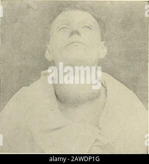 The practice of surgery . ^ contains portions of tissue of the normal thyroid type.Proliferating goiter has a firm, compact feel and is not large; (3) metas-tatic colloid goiter. This is a rare and curious growth, resemblingclosely the well-known nodular goiter; (4) papilloma, which may be nod-ular or diffuse; (5) cancroid scjuamous epithelial cancer—an extremely. Fig. 400.—Cancer of thyroid gland (Halstead). rare disease; (6) glycogen-containing epithelial goiter—a growth whichdevelops in nodular goiter and grows rapidly. The cells are large andcontain varying amounts of glycogen and large nu Stock Photo