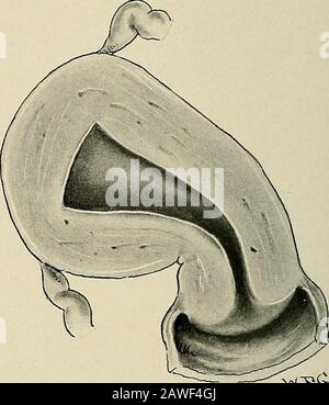 Gynecology . Fig. 179.—Lateral Version.. Fig. 180.—Lateral Flexion. Lateral flexion means a bending of the uterine body on the cervix to theright or left. If there has been also a version involving the cervix, one speaks ofright or left version-flexion. Anteflexion relates to forward angulation between the body and cervix.The uterus is normally anteflexed to a certain degree. The term anteflexionis used to denote an abnormal amount of angulation. The condition is de-scribed more exactly by hyperanteflexion, a word that is not in common use. Retrocession is a specialized term that relates to a Stock Photo