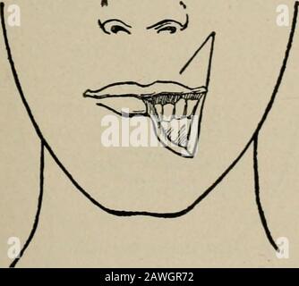 Operative surgery, for students and practitioners . Fig. 127.—Langenbeck Method of Re-storing the Lower Lip. An oval flap istaken from the region of the chin. Fig. 128.—Oval Flap is Raised and Su-tured into Place and the Defect thusClosed. of the skin to form the free margin of the new lip. The lateraldefect on either side is then closed. The scars that result are uponthe cheek.. Stock Photo