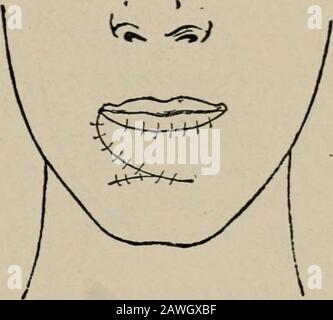 Operative surgery, for students and practitioners . Fig. 127.—Langenbeck Method of Re-storing the Lower Lip. An oval flap istaken from the region of the chin. Fig. 128.—Oval Flap is Raised and Su-tured into Place and the Defect thusClosed. of the skin to form the free margin of the new lip. The lateraldefect on either side is then closed. The scars that result are uponthe cheek. Stock Photo