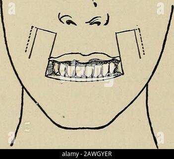 Operative surgery, for students and practitioners . ^ cut long, are sutured to the skin. Finally the semilunar. Fig. 125.—Bruns Method of Restoringthe Lower Lip. Dotted lines indicatethat the mucous membrane is cut longerthan the skin in order to provide amucous membrane border to the new lip. Stock Photo