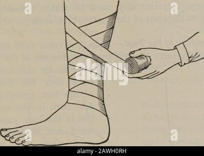 Practical nursing : a text-book for nurses . Bandages, Strappings and Splints 465 make traction on the bandage with the right handto draw it well into place. Make each reverse di-rectly above the preceding one. By thus reversingthe bandage, the turns can be adjusted to the con-tours of the body. The reverse is used principally for the legs and arms. The Figure-Eight Bandage.—The figure-eightbandage consists of a series of oblique turns alter-. ing. 39. Figure-Eight Bandage nately ascending and descending and crossing eachother in such a manner that they form the figure-eight. The figure-eight Stock Photo