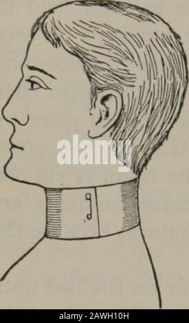 Practical nursing : a text-book for nurses . Fig. J7. Spiral Reverse Reverse above. Bandages, Strappings and Splints 465 make traction on the bandage with the right handto draw it well into place. Make each reverse di-rectly above the preceding one. By thus reversingthe bandage, the turns can be adjusted to the con-tours of the body. The reverse is used principally for the legs and arms. The Figure-Eight Bandage.—The figure-eightbandage consists of a series of oblique turns alter- Stock Photo