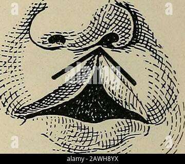 Operative surgery, for students and practitioners . Fig. 99.—Result After Suture. Fig. 100.—Malgaigne Operation forIncomplete Harelip. Paring and for-mation of flaps. into a vertical one its edges are united with several interruptedstitches. Malgaigne proposed to close the defect, especially where thedefect is considerable, by making use of flaps in addition to fresh-ening the edges. In his operation the tissue is removed from the Stock Photo