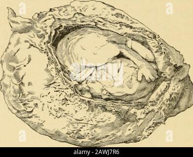 A system of obstetrics . si- An Embryo surrounded by Thickened ...