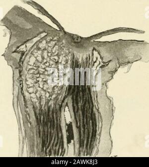 The Journal of nervous and mental disease . ered away and her mem- MYRTELLE M. CAXAVAN orv failed. Pupils were irregular and unequal, but reacted tolight and accommodation. Xo ophthalmoscopic examination wasmade. Wassermann reaction not done. She had absent knee jerks, speech defect, ataxia, tremors andRomberg, and her judgment was poor, and she gave evidence ofdementia. Sections of the brain show marked infiltration of vessels, dis-order and destruction of cells, and sections of the cord show agummatous meningitis; over mid-dorsal region, and posteriorcolumn sclerosis. The optic nerve shows s Stock Photo