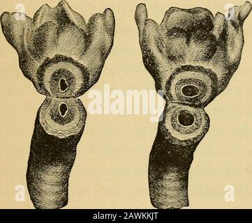 Diptheria, its nature and treatment . iable. Fig. 7 represents the normal lumen of the subglotticdivision of the larynx from a child of the same age, and Fig.8 a section from the trachea of the same showing the greatdifference in the caliber of the air passage at these points. I have used the 5-7 tube at two years of age either to ob-tain the benefit of the increased length or larger head, and FORMS OF STENOSIS OF THE LARYNX. 269 this can be adopted where there is pseudo-membrane produc-ing- obstruction at the lower extremity or swollen tissue over-lapping the head of the smaller tube. Greater Stock Photo