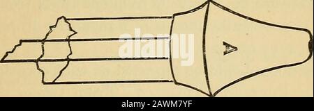 Diptheria, its nature and treatment . Fig. 15.—Ear-Syringe Padded. shown in figure 16. As this requires but a moment, the pad-ding- may be changed after each syringing. A glass syringe expressly designed for this purpose, the. Fig. 16.—Peerless Syringe, No. 4. nozzle of which is protected by a covering of soft rubber, ismanufactured by R. Van der Emde, 323 Bowery, New York, and is called Peerless Syringe, No. 4. Stock Photo