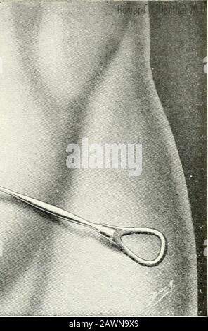 Sajous's analytical cyclopædia of practical medicine . The Dotted Line Shows Line of Section. The Bhint Retractor Holds Outer Third of Rectus Muscle Together with Skin and Aponeurosis. (Hoivard Lilietithal.) Annals of Surgery. Stock Photo