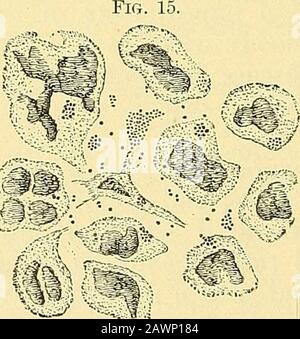 A practical treatise on medical diagnosis : for students and physicians . y to pneumonia. The bacillus coli communis is found inabscesses about the peritoneum and in purulent peritonitis, the amoebadysenterica in abscess of the liver and secondary abscess of the pleuraand lung. It was found in an abscess of the jaw by Flexner. Themicrococci are detected by the staining methods. The method of Gramis the most satisfactory. After a cover-glass has been prepared and placed in Ehrlich-Weigertssolution of gentian-violet and aniline water, it is put into a solution ofiodine and iodide of potassium fo Stock Photo