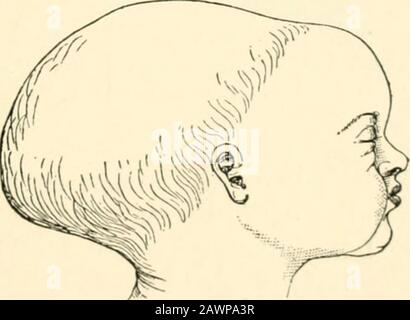 A textbook of obstetrics . Fig. 608.—face presentation (Schroeder 1. Si ...