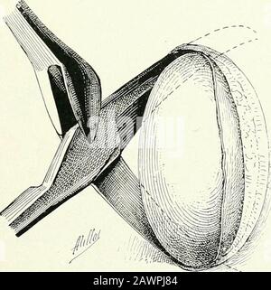 Surgical therapeutics and operative technique . Fig. 100.—Wound formed ...