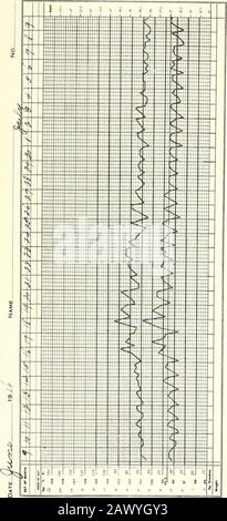 Clinical tuberculosis . my temperature curve from that taken on awakeningin the mornins. twelve, four and eight oclock unless the maximumshould fall on some other hour. Fig. 113, Vol. II, shows a normaltemperature curve for the day, while Figs. 76 and 77 show the im-portance of the early morning record. There are many sources of error in taking temperature. Inthe first place, the thermometer should be held in the mouth suf-ficiently long to fully register. I am in the habit of requiringpatients to hold the thermometer a minimum of five minutes, nomatter whether it be a one minute, two minute, Stock Photo
