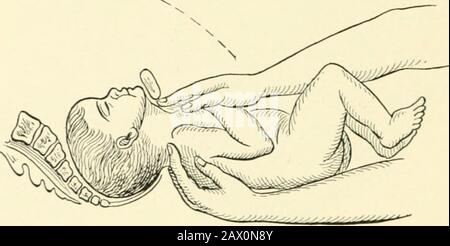 A textbook of obstetrics . Fig. 253. Presentation I the umbili