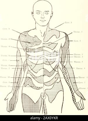 Clinical tuberculosis . Fig. 27.—Heads zones. (Anttrior surface of the ...