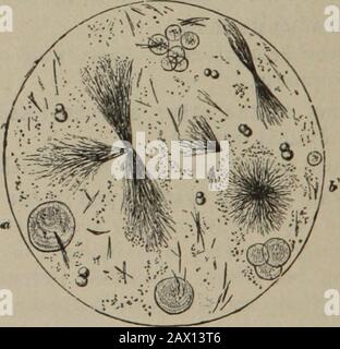 Essentials of practice of medicine : arranged in the form of questions and answers, prepared especially for students of medicine . Crystals of cystin {after Ultzmann). Fig. 18.. (a) Leucin, spheres; (6) Tyrosin, needles and sheaves. How does tyrosin appear under the microscope ? Tyrosin, which appears generally associated with leucin in urinarysedinfents. lias the form of silky, white, microscopic needles which ar«arranged in sheaves or stellate form (Fig. 18). URINARY SEDIMENTS. 53 In what compound is oxalic acid occasionally present in theurine? As calcium oxalate, which is frequently found Stock Photo