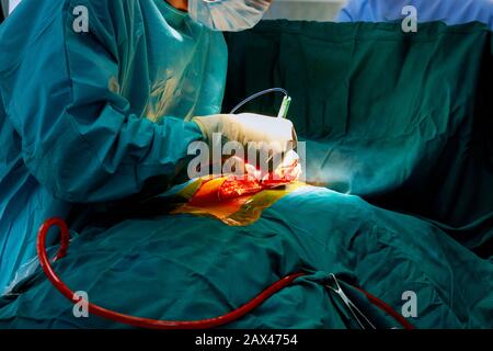 Suture of an lung emphysema surgery in an infant andmedical assistance close-up Stock Photo