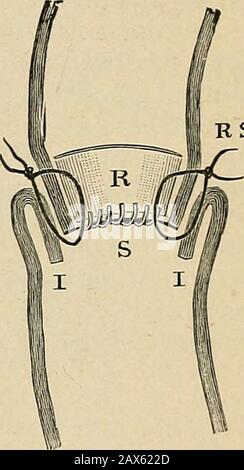 Surgery; its theory and practice . Maunsells method of circular ...