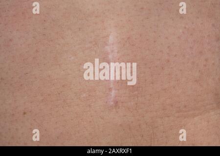 Close-up of a postoperative keloid scar on the skin of a man's abdomen. Stock Photo