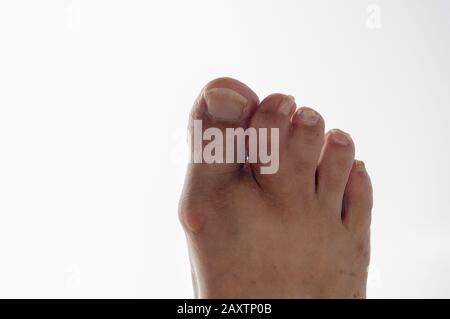 Human foot with conjoined toes Stock Photo - Alamy