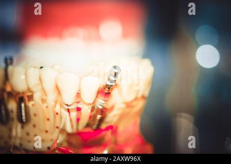 Transparent Model of Human Teeth with implants close-up Stock Photo