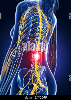 3d rendered medical illustration - backache Stock Photo